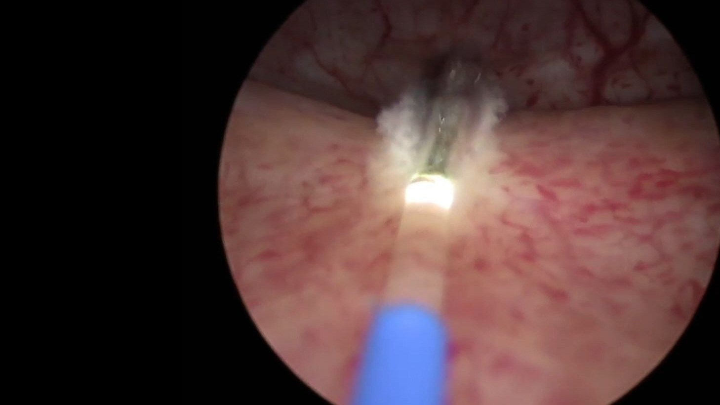 （前列腺增生）铥光纤激光前列腺剜除术