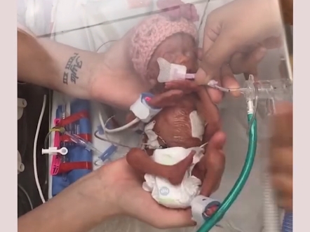 20周的早产婴儿.刚出生时的样子 #村花的奇葩科普