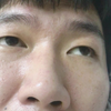 肛周脓肿术后恢复第七天