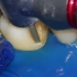 国外牙科显微镜下嵌体制备与粘接（上）