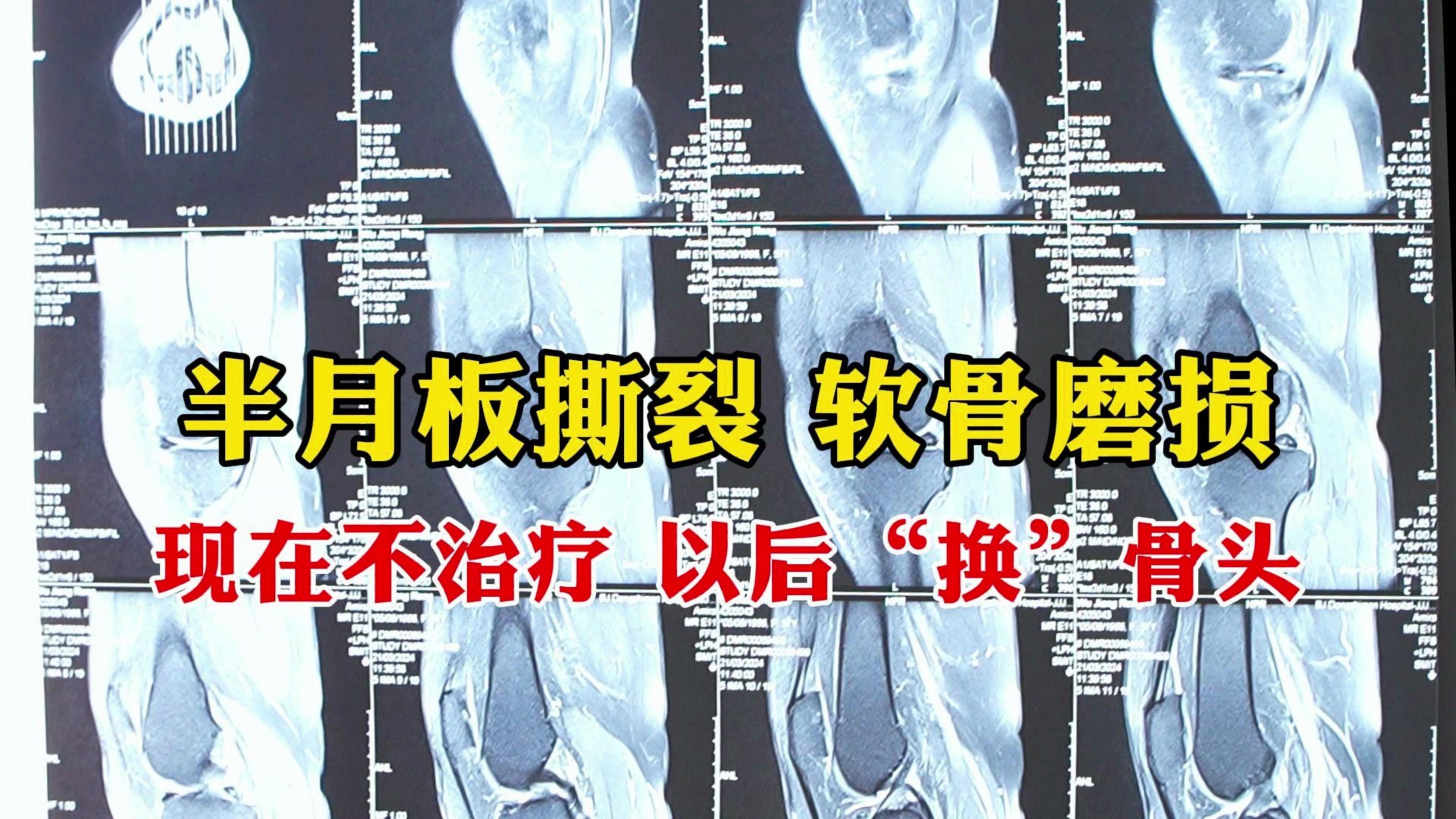 刘向春：42岁大姐半月板撕裂不想手术，主任：现在不做以后就要换骨头