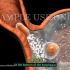 【3D医学动画】胃食管反流病（中英双字幕）