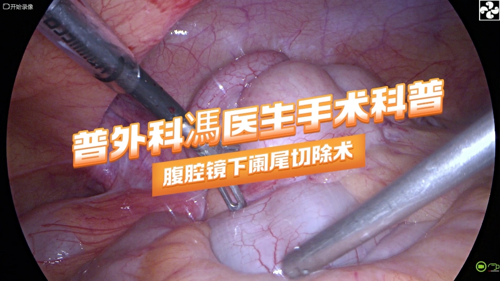 普外科馮医生手术科普-腹腔镜下阑尾切除术