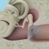 【耳硬化症】镫骨手术动画