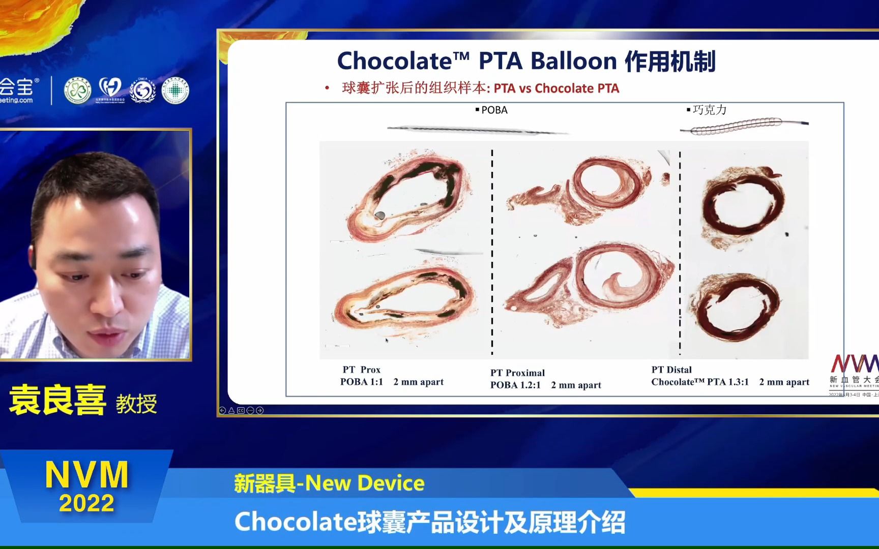 20220604  第一界新血管大会  Chocolate球囊产品设计及原理介绍  袁良喜