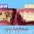 日本大叔牙齿真的很糟糕，牙齿治疗完后年轻十几岁