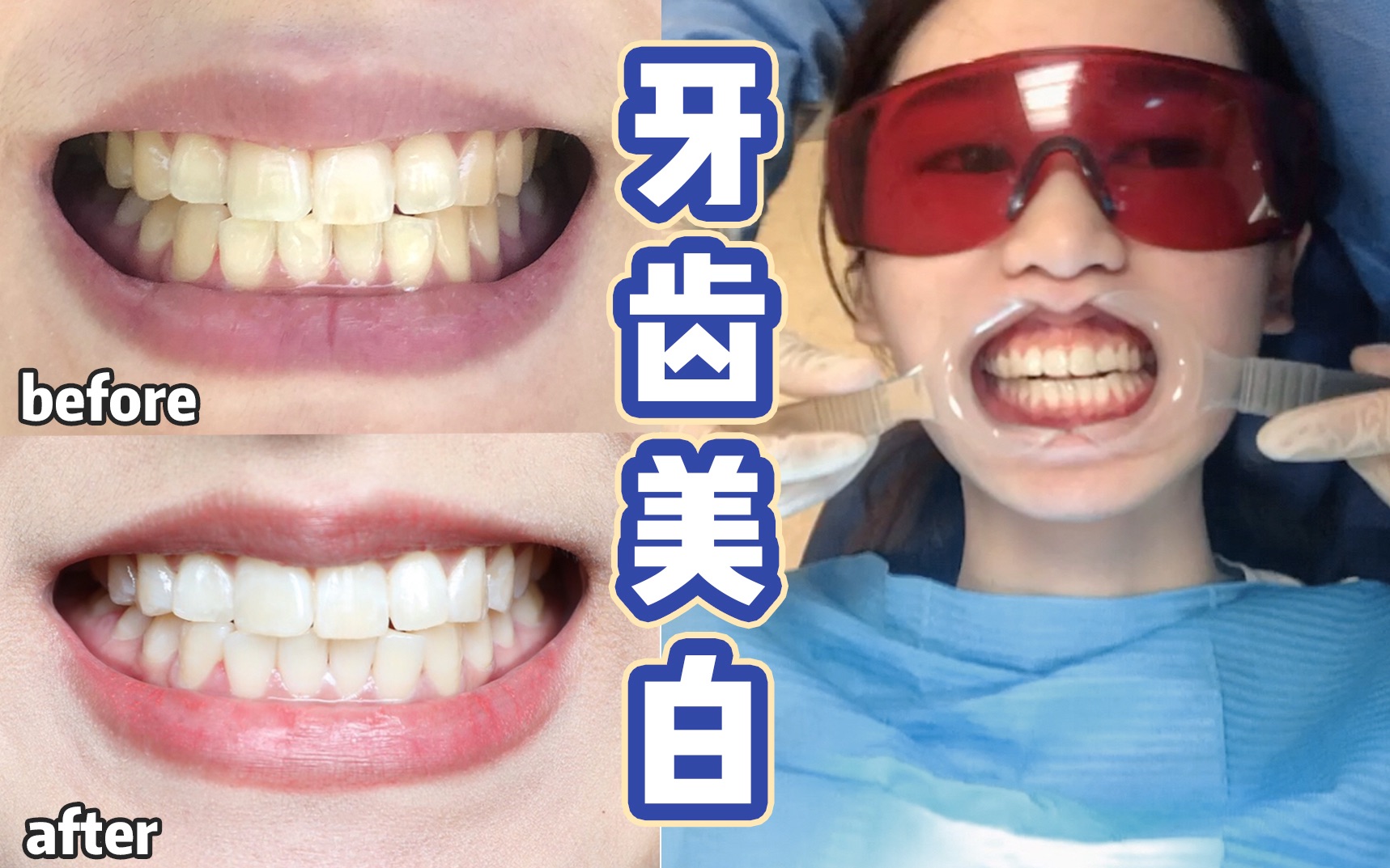牙齿美白的4种方法！白两个度！