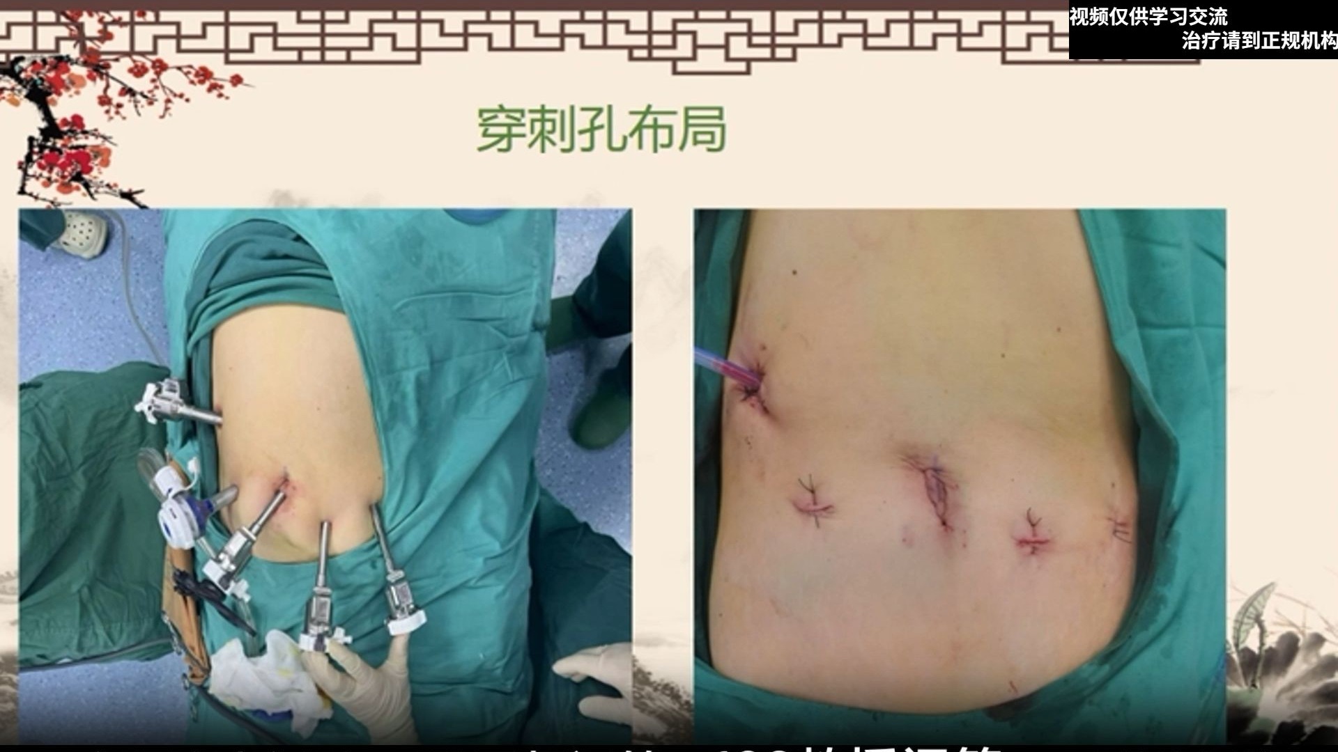 完全机器人腹腔镜远端胃癌根治术