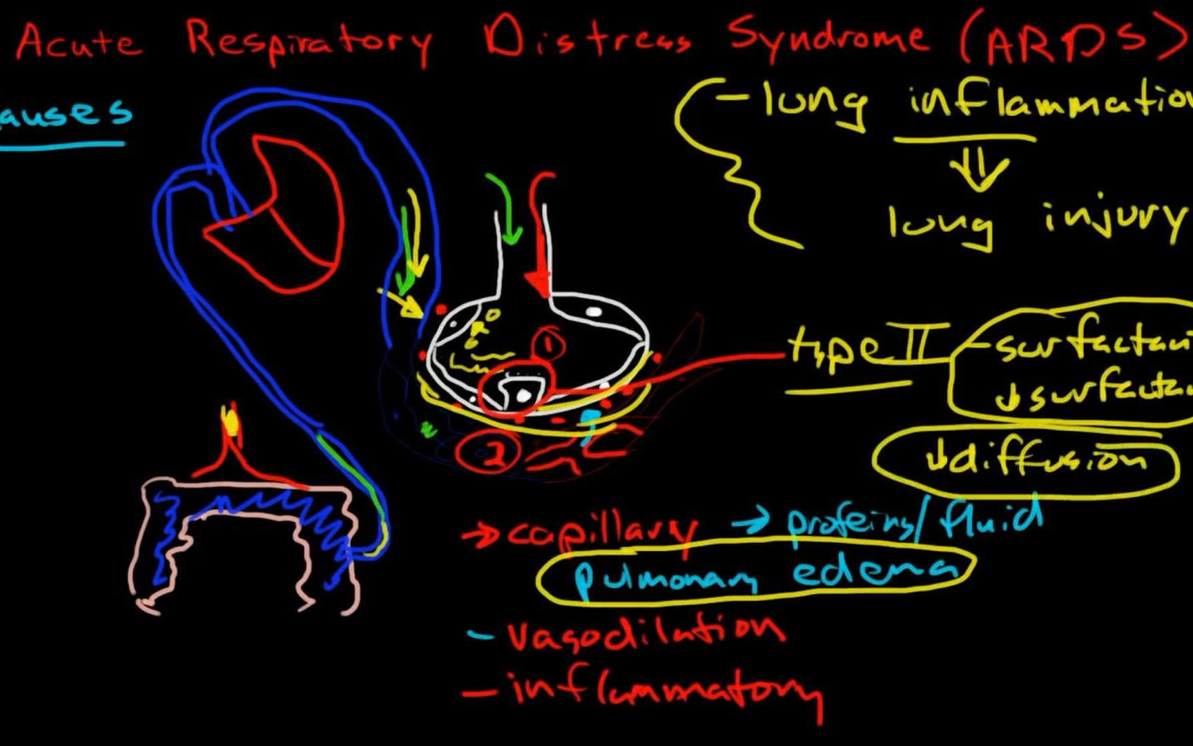 急性呼吸窘迫综合征acuterespiratorydistresssyndrome