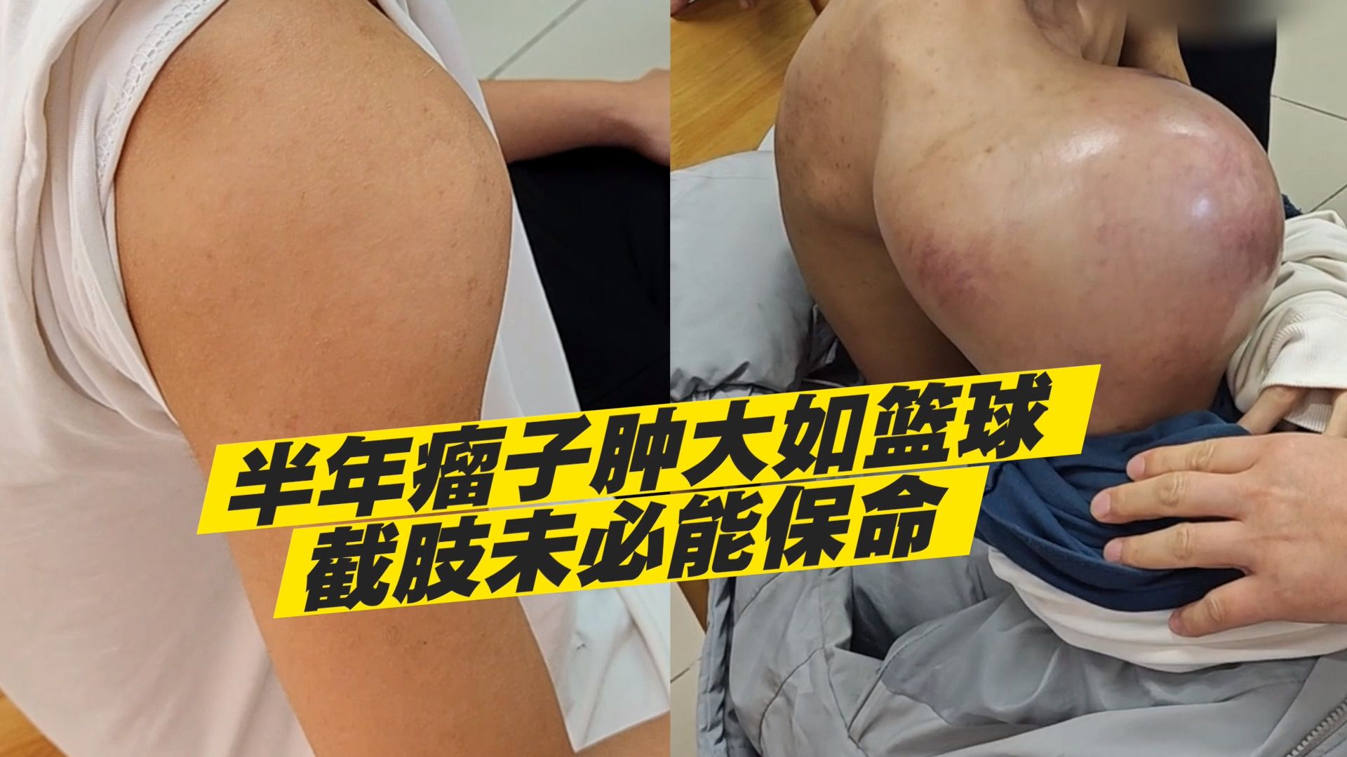 19岁少年确诊骨肉瘤，不遵医嘱耽误半年，肿瘤肿大如篮球，实在让人痛心！