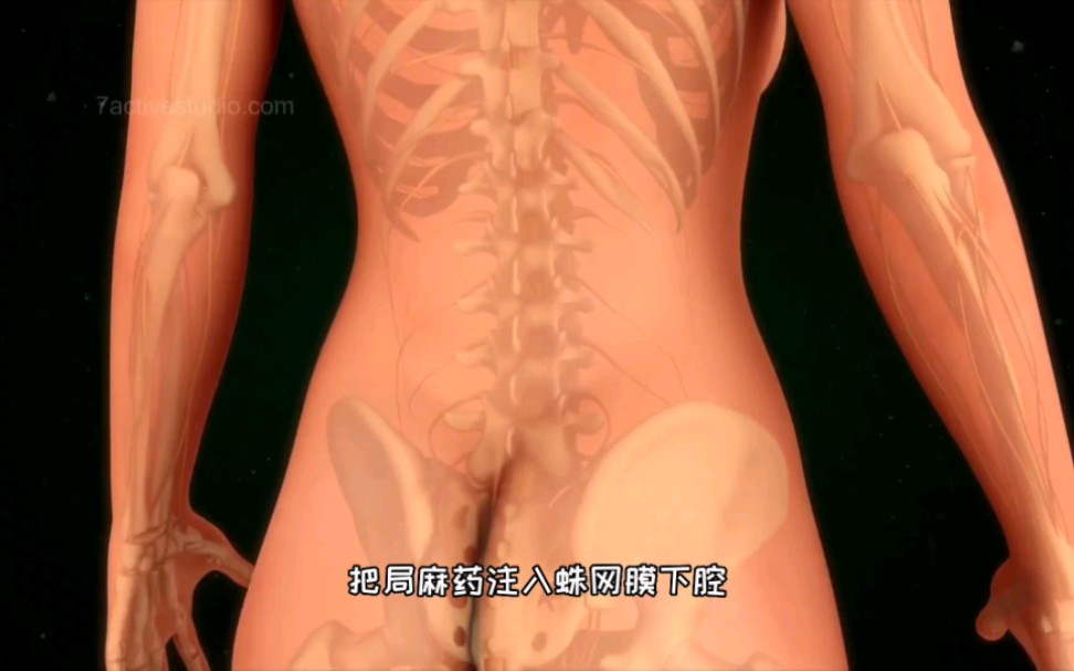 麻醉药过量会死亡，手术麻醉-腰椎麻醉过程，3D演示。。