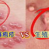 生殖器疱疹与生殖器疣，都是出现在生殖器的性疾病，差别却很大