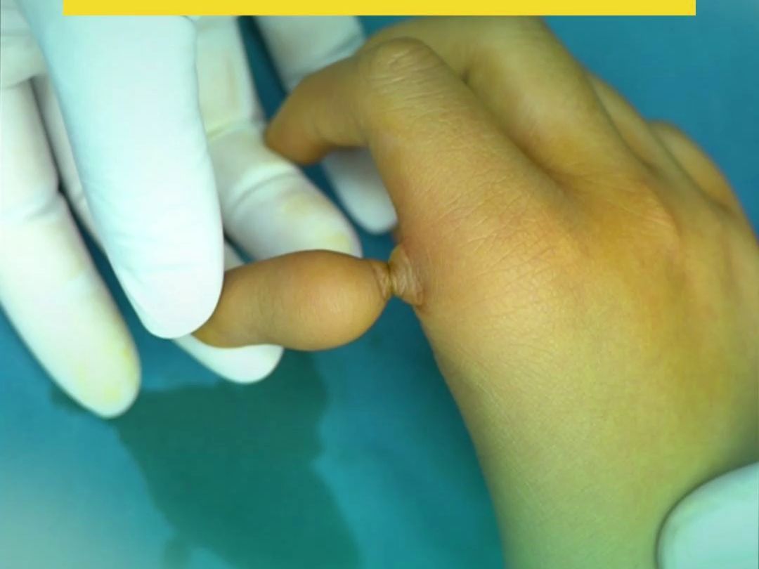 孩子打篮球差点把拇指弄断，半掌骨移植手术重建大拇指