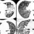 北京大学第一医院高莉-肺部的基本影像解读和鉴别-间质病变（二）