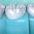 11.看完蛀牙做根管治疗的过程，能补牙的时候你还不趁早补牙吗？