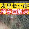 家人们，头上有小痘痘怎么办