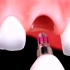 门牙蛀牙严重，即拔即种过程