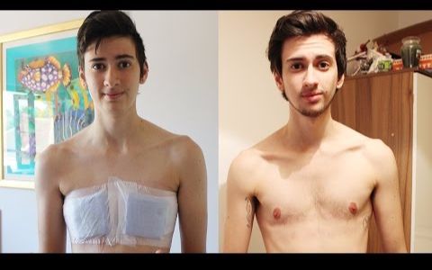 变性经历分享】女变男~身体变化图片~My Gender Transition From Female 