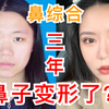 超详细鼻综合解答，做完三年我的鼻子变形了