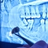 智齿可以移植到旁边的大牙吗？