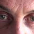 【Argyll-Robertson 瞳孔】Argyll Robertson Pupil