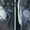 【处女膜闭锁、经血潴留（宫颈管及阴道显著扩张