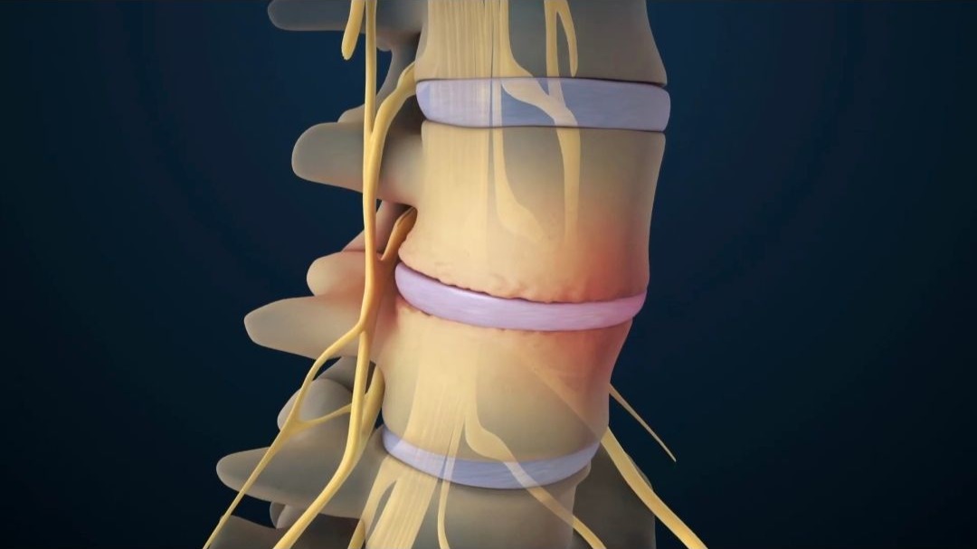 腰椎间盘突出能通过康复锻炼恢复吗，最简单最方便的康复锻炼方法，3D演示。。
