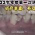 日本22岁宅女第一次洗牙，医生不忍直视，臭气熏天，全是牙结石！