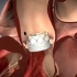 这么先进，介入微创心脏主动脉瓣置换手术过程，3D演示。。