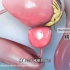 男人不要纵欲过度，前列腺增生的病因和治疗，3D演示。。