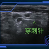 穿刺针进入神经根 哈尔滨中德骨科 超声记录全过程