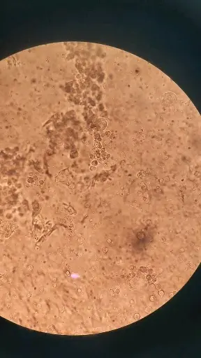 白带滴虫，白细胞以及上皮细胞。