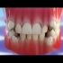 牙齿矫正中，遇到要拔牙的情况，一般是拔除哪颗牙，你可知道？