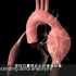 最致命的疾病之一，主动脉瘤破裂发生原因及治疗，3D演示。。