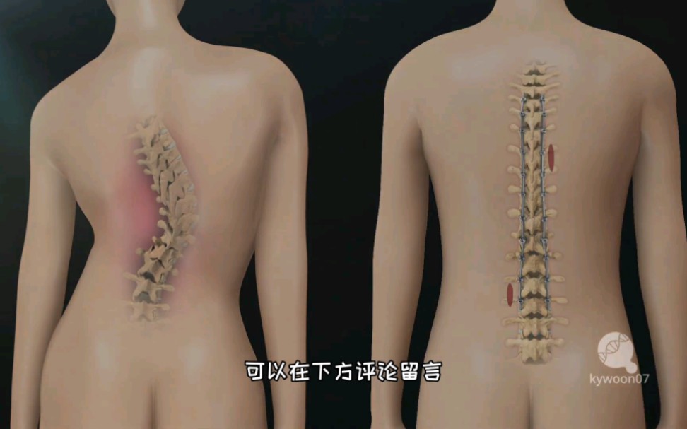 再来一个暴力手术，脊柱侧弯微创手术矫正过程，3D演示。。