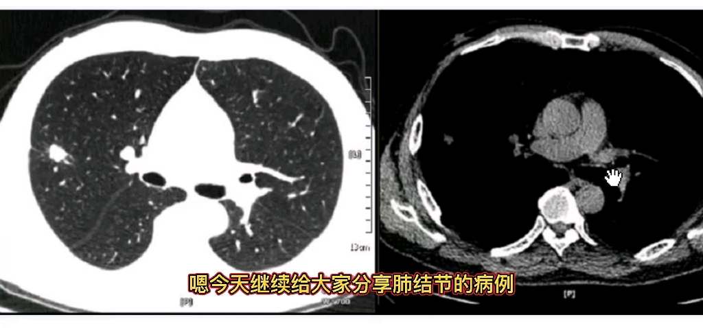 老年男性,发现实性肺结节,最后诊断什么?放射科医生