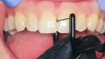 闪亮的好评：中山牙齿矫正冯碧妙医生提醒你，每日正确使用牙线剔牙，不要再用牙签了[一阶段]的第1张示图