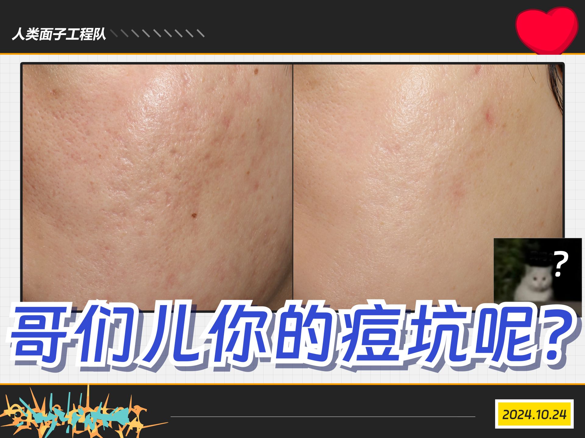 3次痘坑联合治疗直接还你妈生皮！点阵激光+黄金微针+光子嫩肤+刷酸