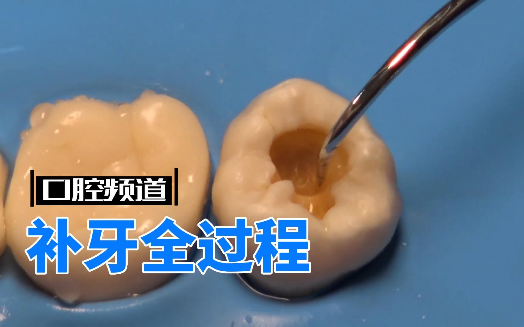 补牙全过程