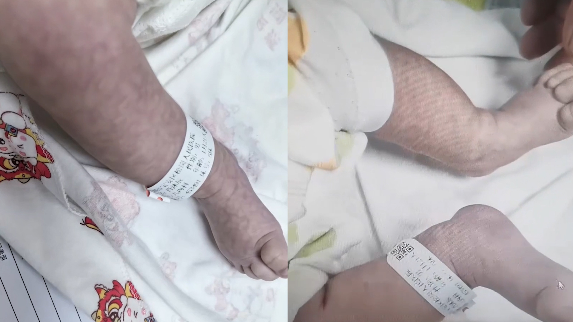 2个月大婴儿高烧，家长擦酒精退烧致其休克抢救：全身布满花斑纹