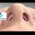 重庆仁品鼻塞鼻炎患者手术医学动画视频