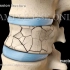 脊柱压缩性骨折-经皮椎体成形术