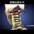 颈椎后路手术是对于多节段颈椎病所采取的一种有效的颈髓神经减压方法。