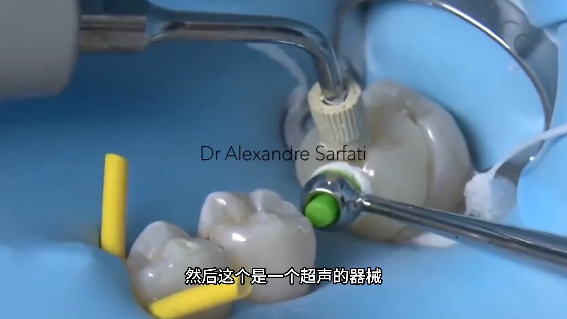 【张林】5天学会做嵌体5——嵌体粘接流程