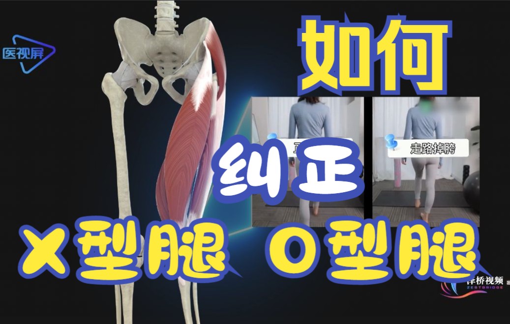 【医学3D】：X形腿和O形腿可以矫正吗？