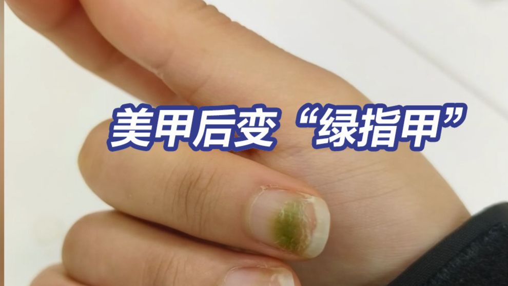 美甲后变“绿指甲”？从种草到“避雷”，美甲暗藏健康隐患。