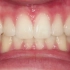 10个牙齿矫正案例前后对比，你的牙是哪一款？
