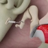 耳朵人工置换手术过程，3D演示。。