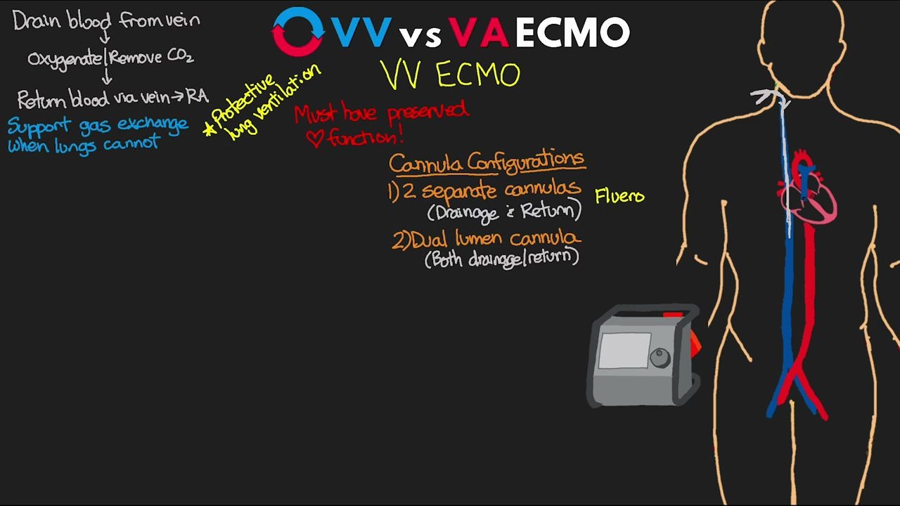 VV vs VA ECMO Explained!_哔哩哔哩_bilibili