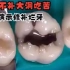 现场演示，牙医修补坏牙，蛀牙，烂牙，看完牙齿舒服多了！！